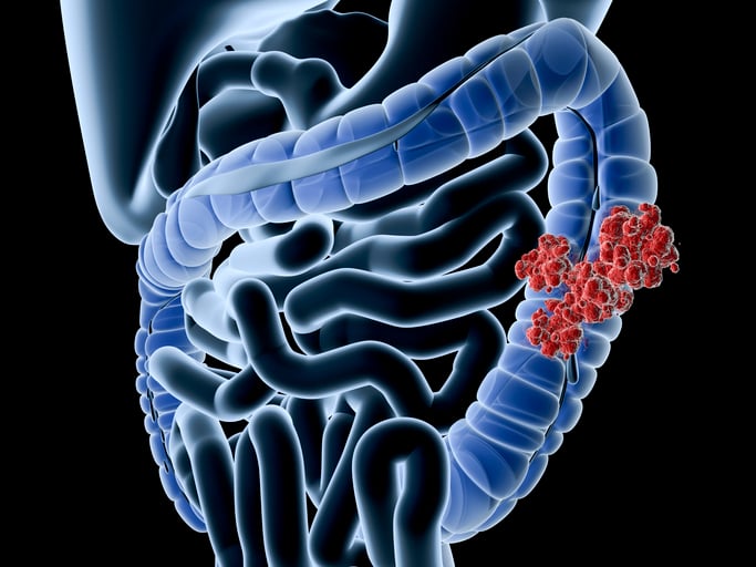 Colorectal Cancer