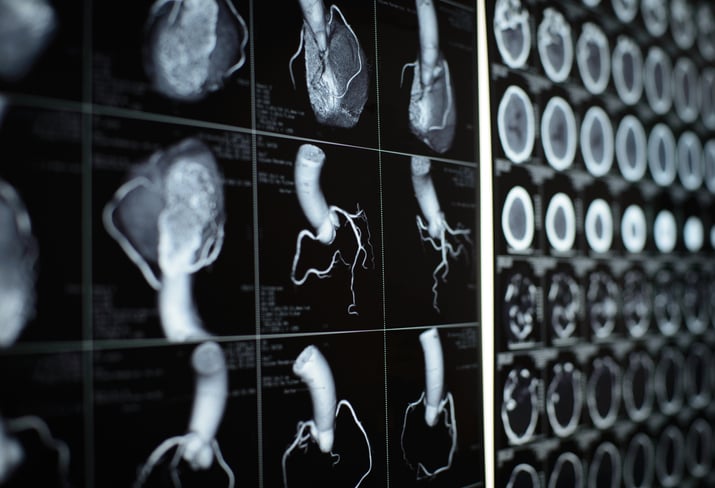 heart disease statistics